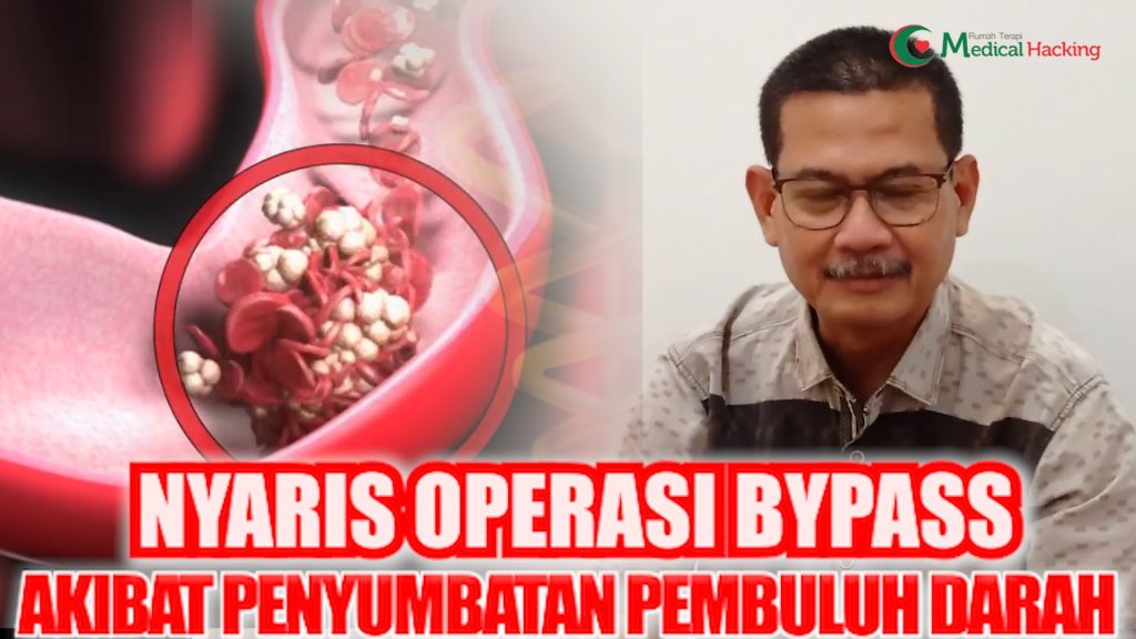 RUMAH TERAPI MEDICAL HACKING - NYARIS OPERASI BYPASS AKIBAT PENYUMBATAN PEMBULUH DARAH JANTUNG